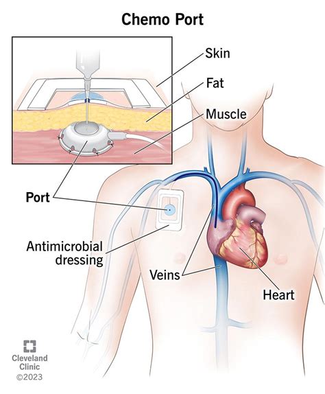 What Is a Chemo Port?