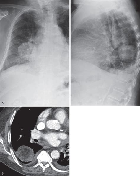 Pulmonary Hamartoma | Radiology Key