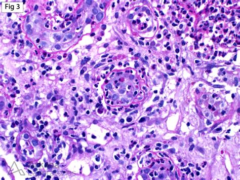 Acute Pyelonephritis | Teaching Points | Arkana Laboratories