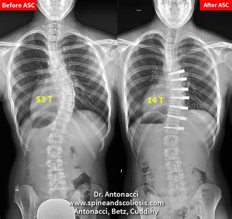 Before and After Scoliosis Surgery Case Studies