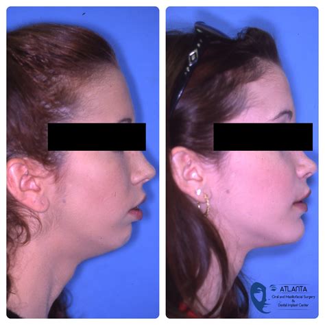 Jaw Surgery Alpharetta GA | Corrective Jaw Surgery