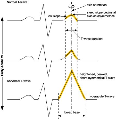 Hyperacute T Waves Vs Peaked T Waves