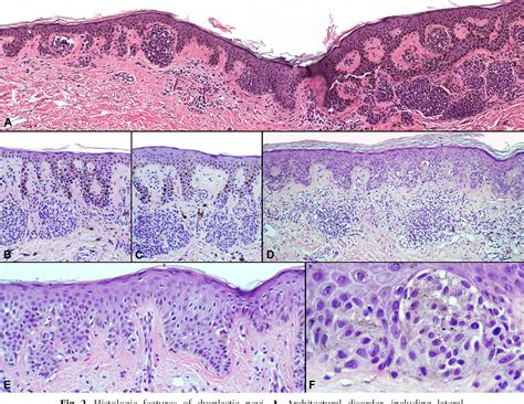 Figure 2 from The dysplastic nevus: from historical perspective to ...