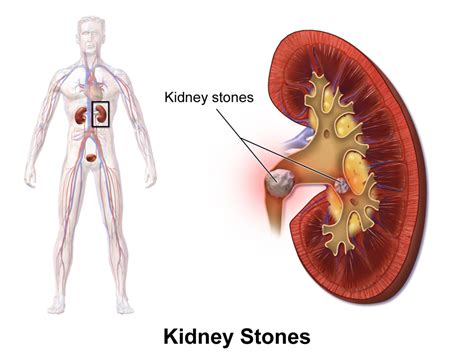 Kidney Stones Symptoms, Causes and Treatment