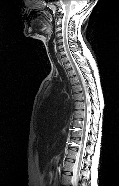 Cervical Spine Mri Ms