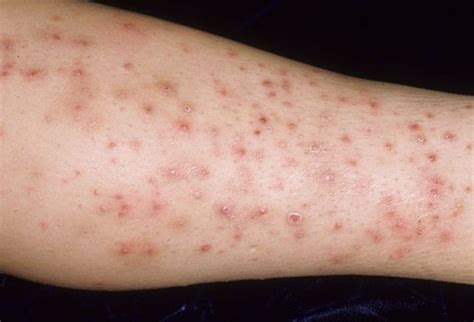 Bacterial Skin Infections: Can You Make the Diagnosis?