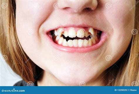 Bad Teeth Stock Photography - Image: 13398592