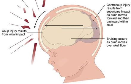 Children And Brain Injury - Northern Brain Injury Association | British ...