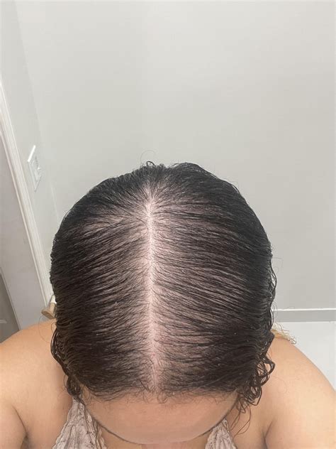 5 month improvement BEFORE AND AFTER : r/FemaleHairLoss