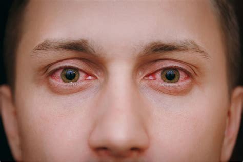 Bloodshot Eyes: Causes, Symptoms & Treatment | MyVision.org