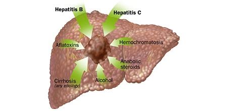 Liver Pain : Location , Causes , Symptoms and Treatment