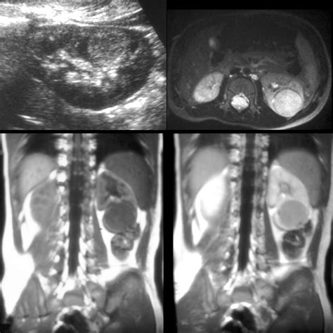 Wilms Tumor | Pediatric Radiology Reference Article | Pediatric Imaging | @pedsimaging