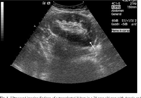 Figure 1 from Diagnosis of acute pyelonephritis by contrast-enhanced ultrasonography in kidney ...