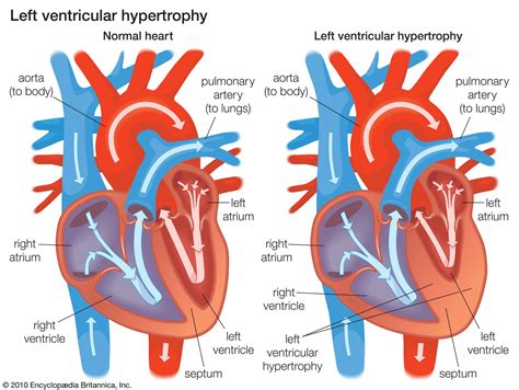 Cardiovascular disease - Ventricular Dysfunction, Heart Failure, Treatment | Britannica