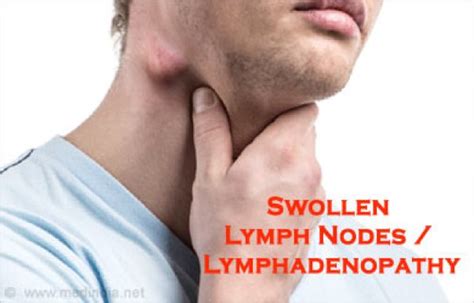 Lymphadenopathy (Enlarged Lymph Nodes) Causes, Definition, Types ...