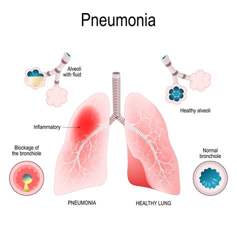 Pneumonia Treatment Thomasville | Pneumonia Dr Lexington