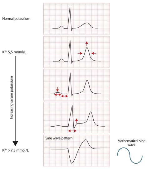 Hypokalemia Hyperkalemia Ecg