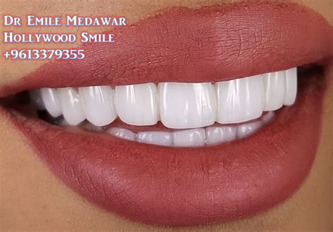 Cosmetic Dentistry, Beautiful Hollywood Smile, Ultra-Thin Digital Porcelain Dental Veneers at ...