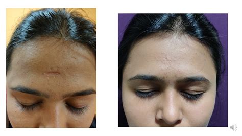 National Skin Centre Scar Removal at Shoshana Baldwin blog