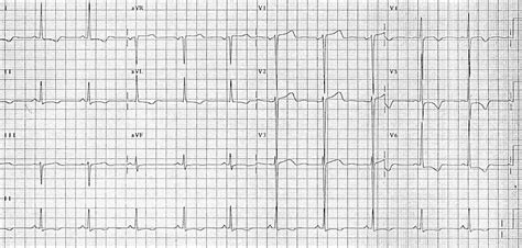 T wave • LITFL • ECG Library Basics