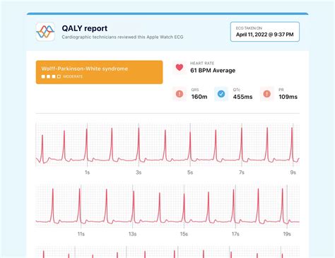 PR Interval on Your Watch ECG - Short, Normal, and Prolonged | Qaly