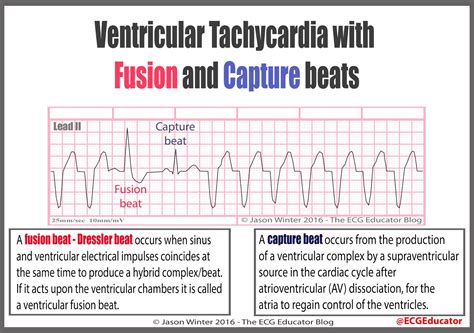 ECG Educator Blog : 11/02/16