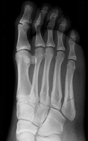 5th Metatarsal Base Fracture - Foot & Ankle - Orthobullets