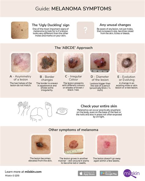 Melanoma Symptoms and Signs: Extensive Guide