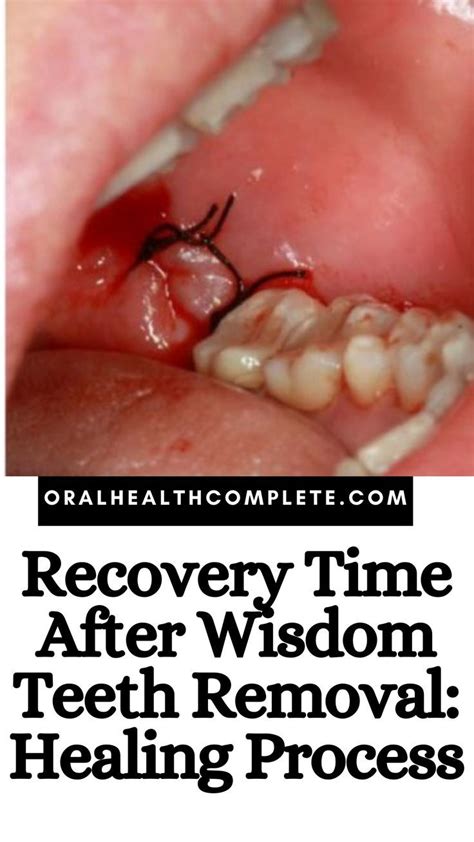 Recovery Time After Wisdom Teeth Removal: Healing Process | Wisdom ...