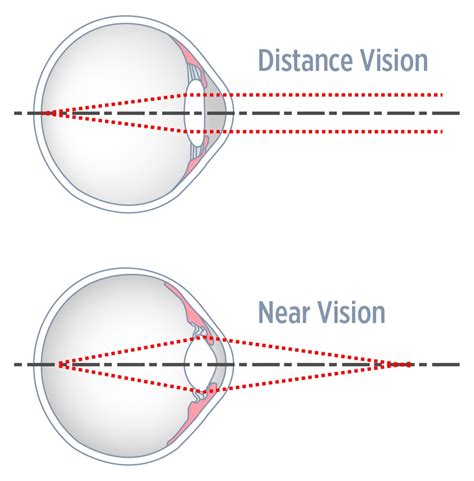 Eye Focusing (Accommodation) - Eyecare Kids