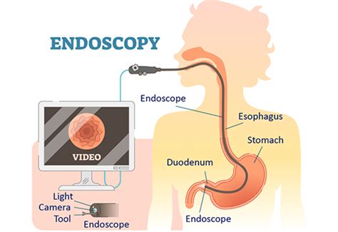 Upper GI Endoscopy | Johns Hopkins Medicine