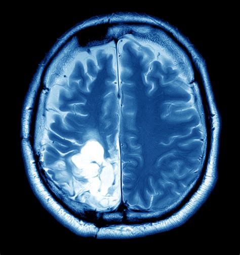 Brain Tumor Overview - Harvard Health