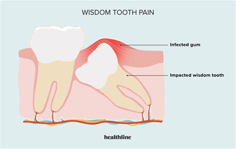 Wisdom Tooth Pain: Relief, Treatment, and More