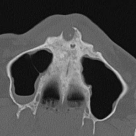 Periapical cyst | Radiology Reference Article | Radiopaedia.org