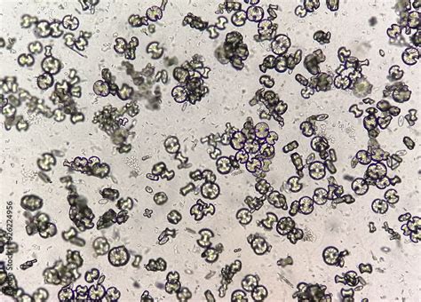 Microscopic image showing calcium oxalate monohydrate, uric acid ...