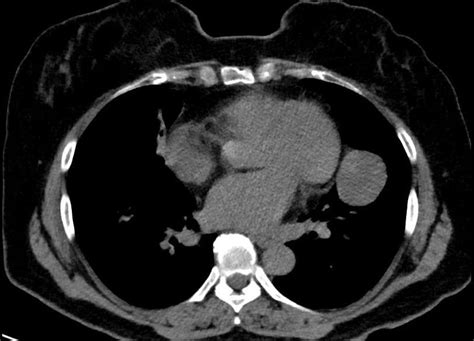 The CT thorax section of pulmonary hamartoma evaluated as a mass in the... | Download Scientific ...