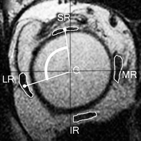 Figure 2 from Heavy eye syndrome versus sagging eye syndrome in high myopia. | Semantic Scholar