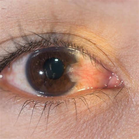 10 Of The Most Common Eye Problems In The World