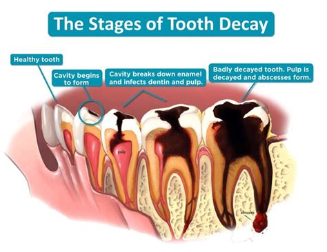 Tooth Decay - DENTAL EXCELLENCE