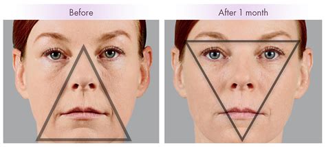 Using Fillers for Cheeks - Charleston Facial Plastic Surgery