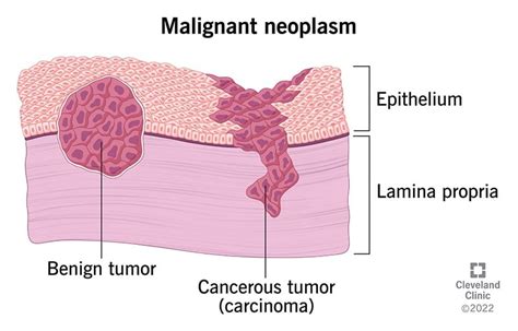 Malignant Neoplasm: What It Is, Types & Factors