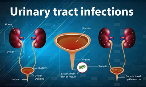 5 Home Remedies for Urinary Tract Infection - Allcare Health NJ