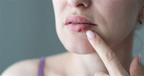 Cold Sores: Causes, Treatments, and Prevention | University of Utah Health