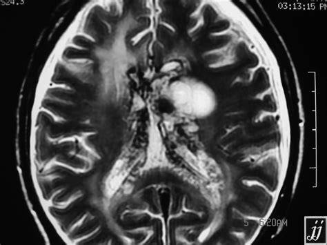 Left optic nerve tumor – Radiopaedia