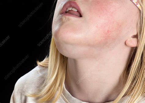 Swollen chin - Stock Image - C038/2318 - Science Photo Library