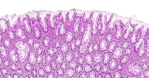 Sessile Polyp Histology