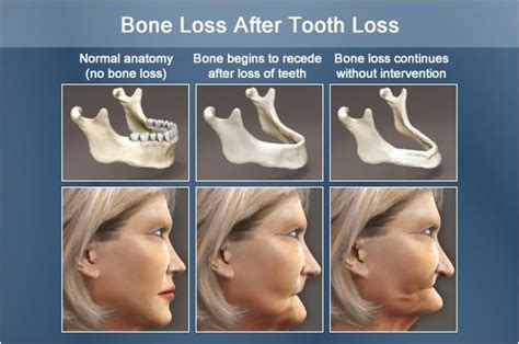 Facts on wearing dentures | Bone loss, Dental world, Dentures