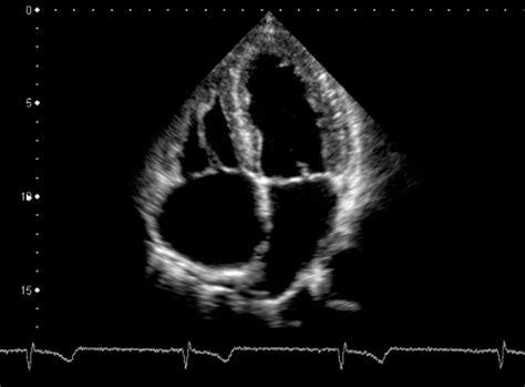 Heart Ultrasound Images : The heart is a perpetually. - Go Images S