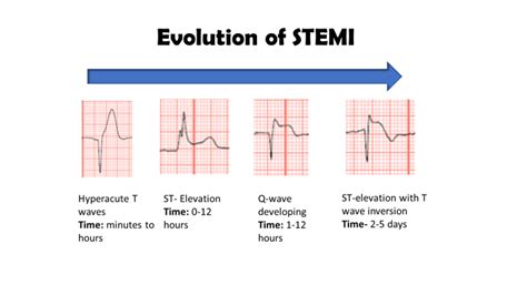 STEMI (ST Elevation Myocardial Infarction): Diagnosis,, 42% OFF