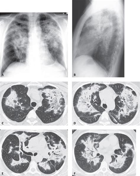 110 Cryptogenic Organizing Pneumonia (COP) | Radiology Key